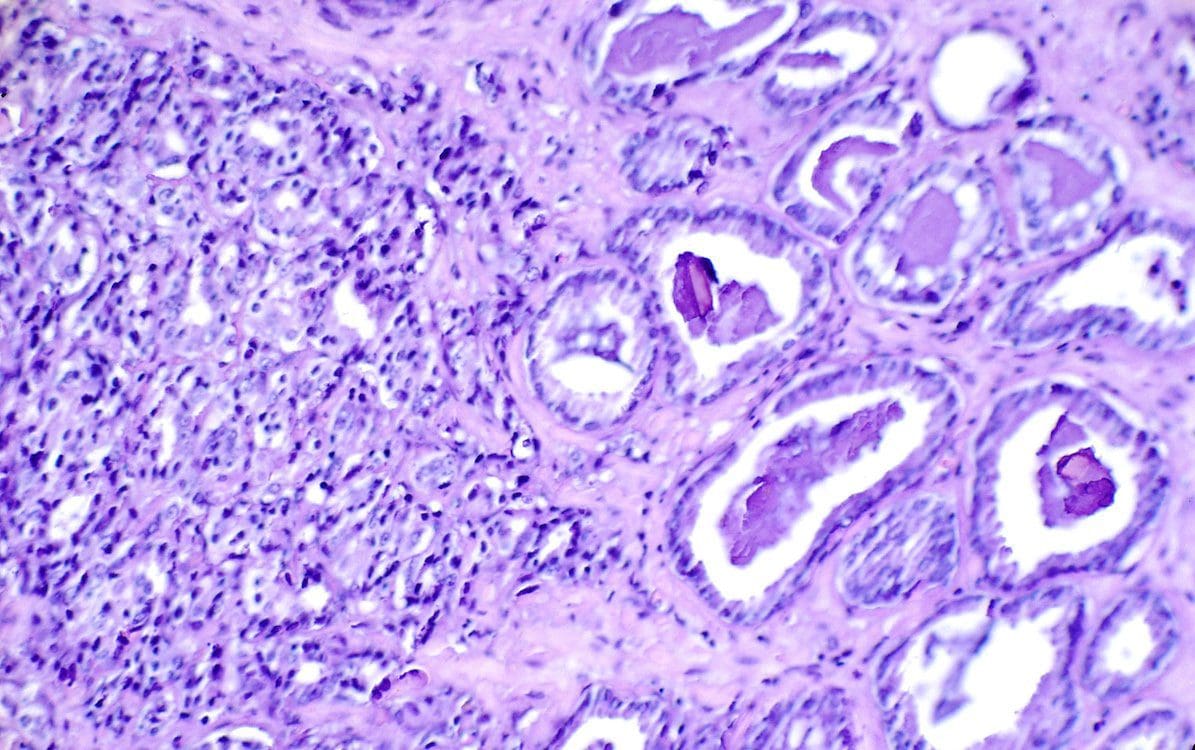 A histological slide (H & E stain at 300x) showing prostate cancer.